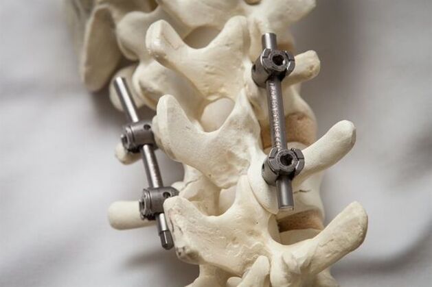 a gerinc rögzítése a nyak osteochondrosisában