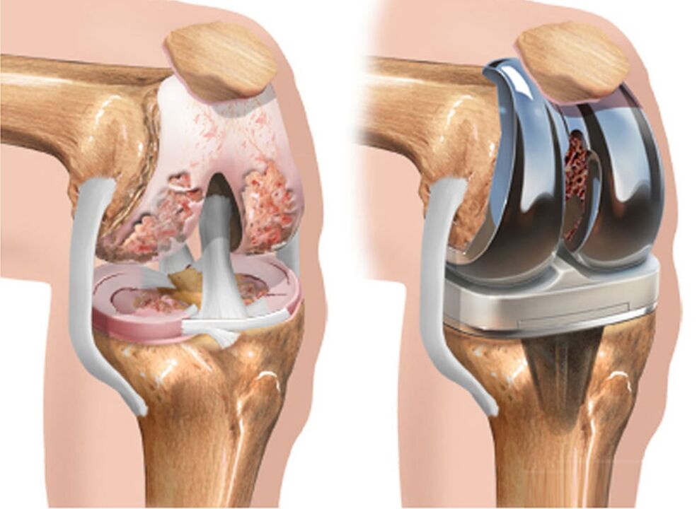 a térdízület artrózisa előtt és után artrózis esetén