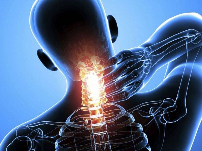A nyaki gerinc osteochondrosisát nyaki fájdalom kíséri