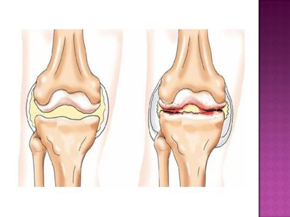 Az ízület normális (bal) és osteoarthritis érintett (jobbra)