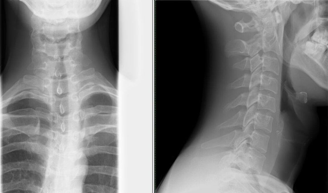 A gerinc röntgenfelvétele egyszerű és hatékony módszer az osteochondrosis diagnosztizálására