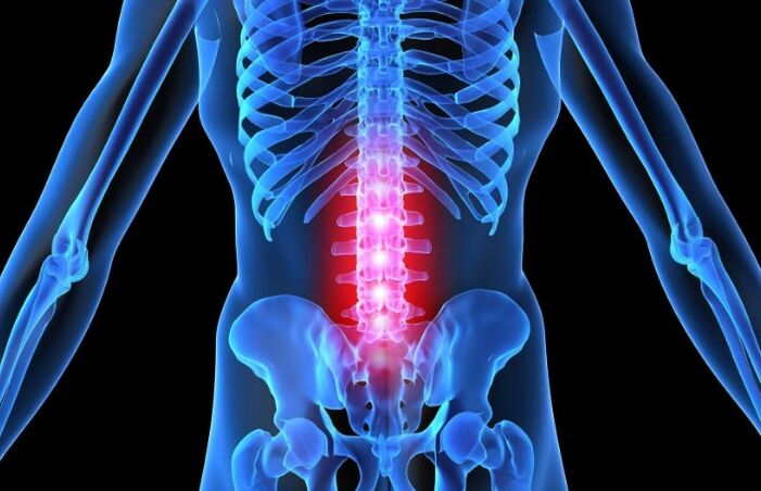 Az ágyéki régió osteochondrosis
